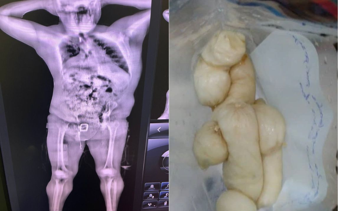 Aduana cubana detecta pasajero con 48 cápsulas de cocaína en Aeropuerto José Martí