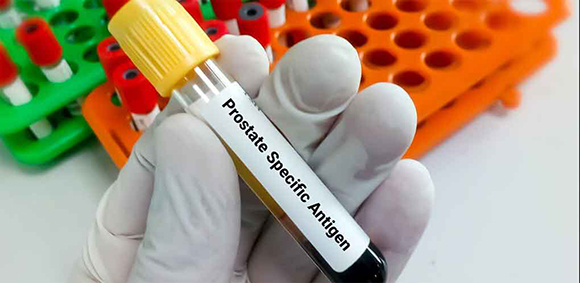 Avance científico en el tratamiento del cáncer de próstata: nuevo enfoque contra