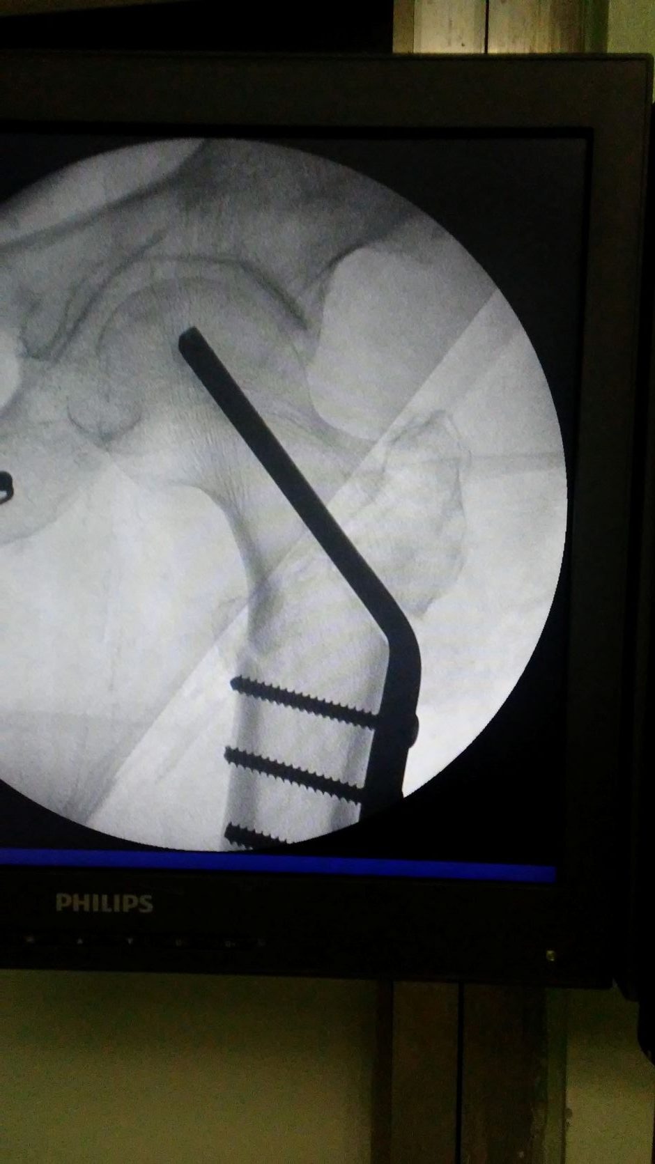 Innovación en ortopedia