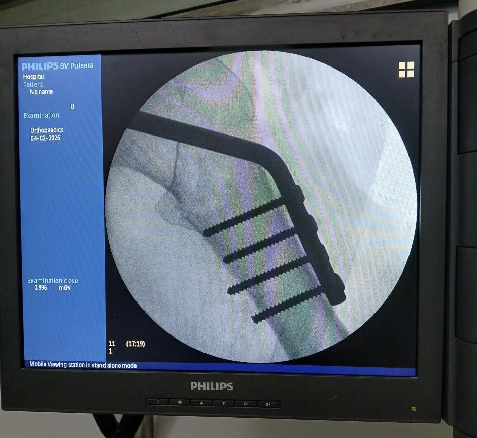 Cuba adapta tornillos quirúrgicos para cirugías de cadera ante escasez de recursos